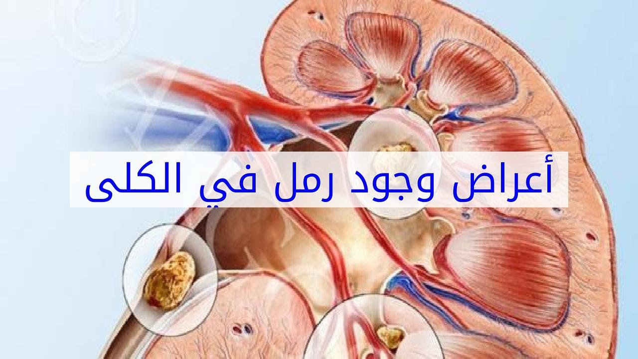 اعراض الكلى , لها الكثير من الأعراض