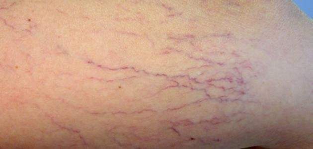 اسباب دوالي الخصية 13104 1