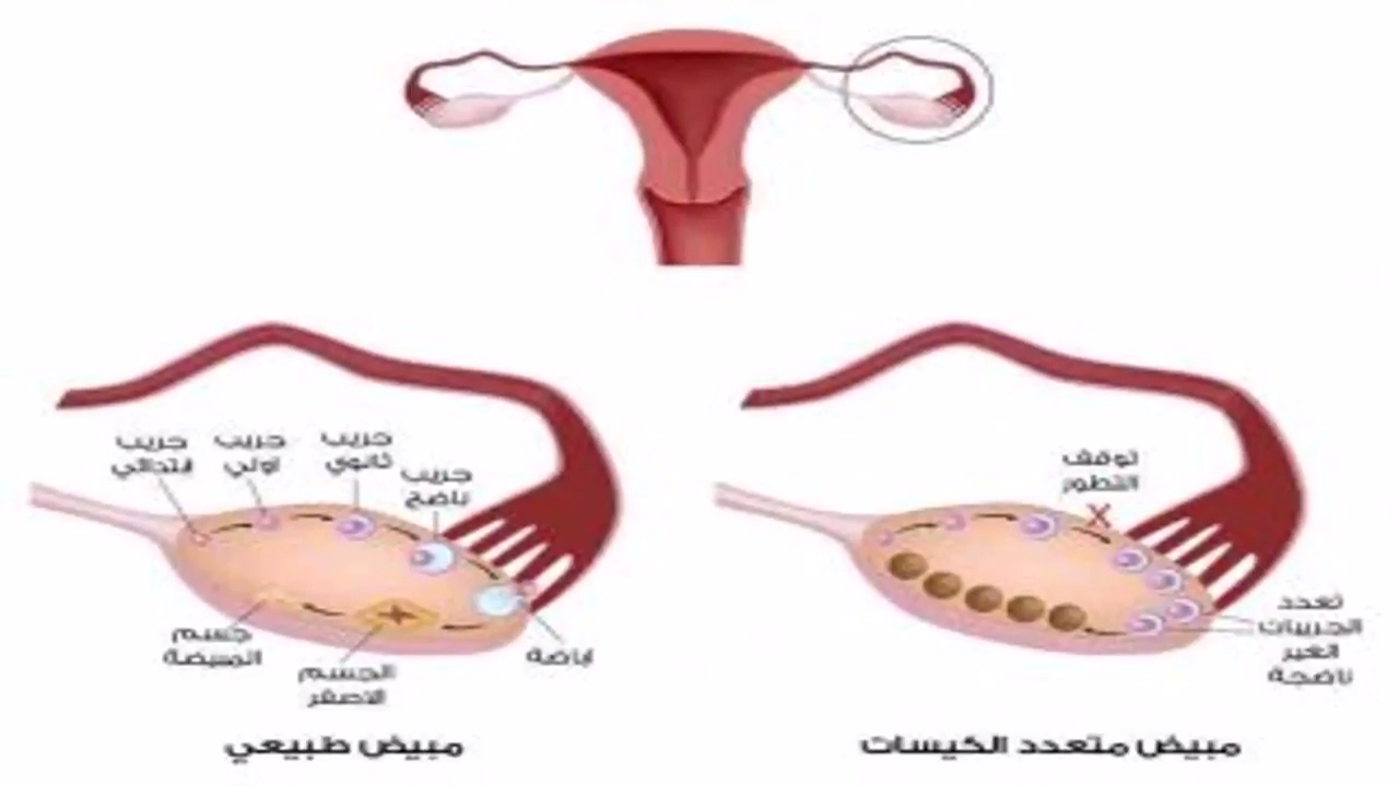 اعراض تكيس المبايض - من اسباب تكيس المبايض واعراضه 4306 2