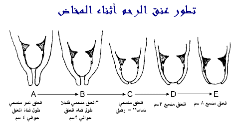 الرحم مفتوح 1 سم والطلق خفيف 12951 1