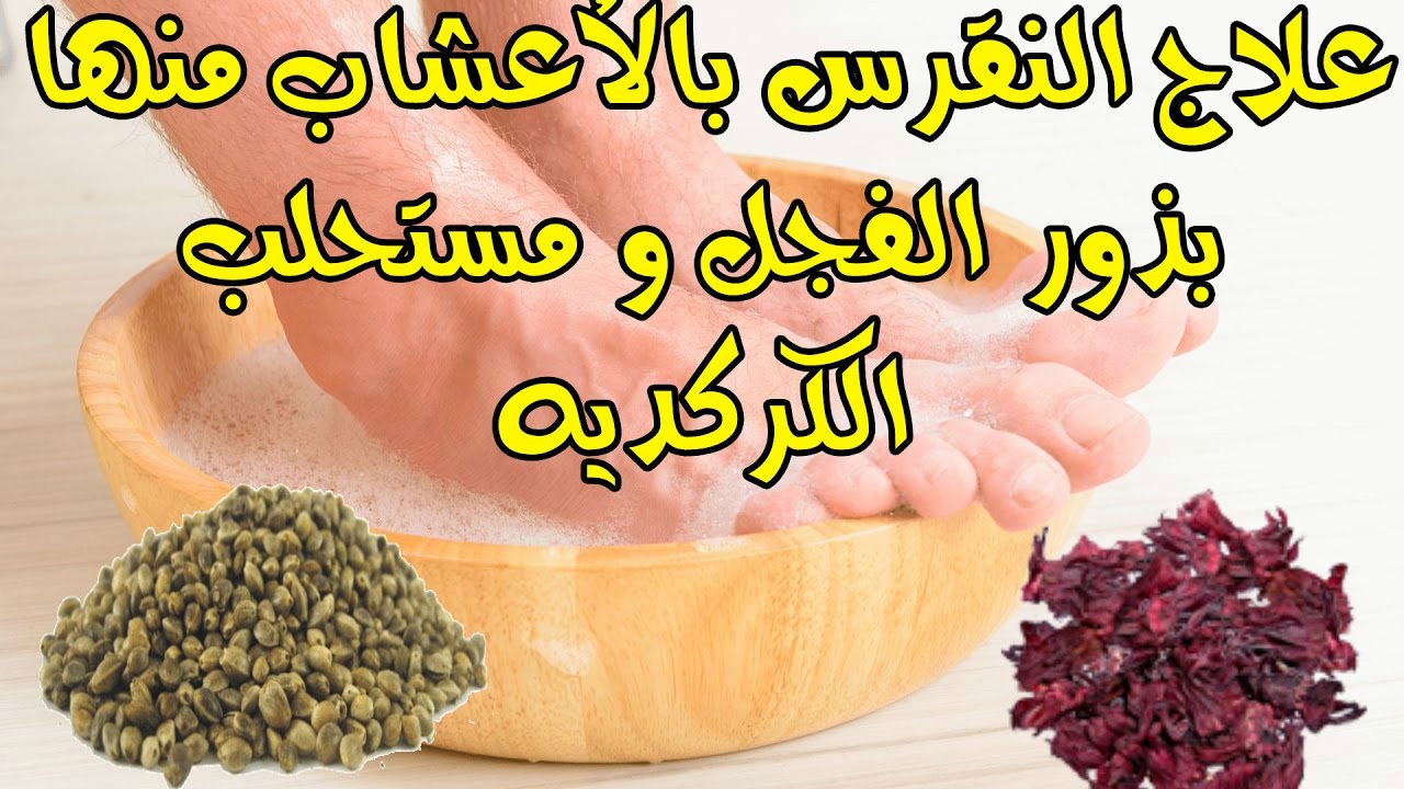 علاج النقرس - طريقةكثيره لعلاج النقرس 4488