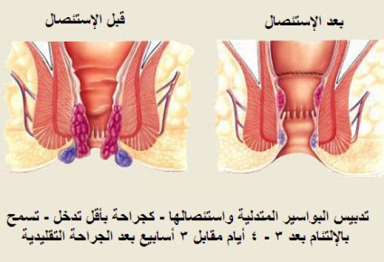 علاج الناسور - خطر مرض الناسور 586 2