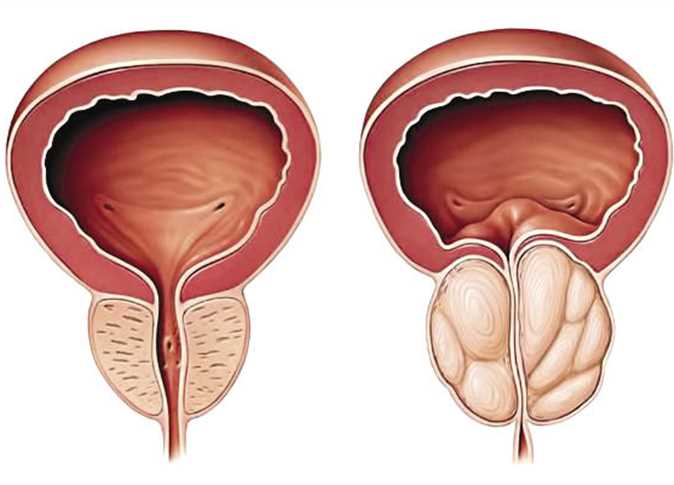 اعراض البروستاتا , تعرف على ما هي اعراض البروستاتا