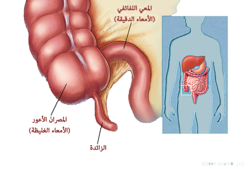 اعراض الزائدة الدودية - من يعانى من الزائدة الدودية 2243 1