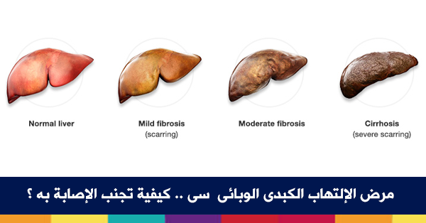 مرض الكبد الوبائي - علاماتة واعراضة وطرق علاجة 1150