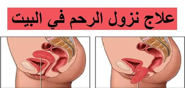 عملية هبوط المهبل - علاج هبوط المهبل 11844 1