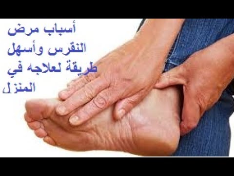 علاج النقرس بالاعشاب - اهم طرق علاج النقرس 3609