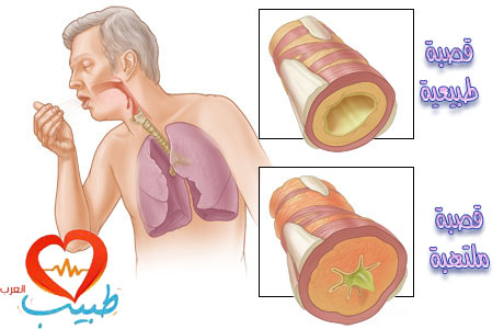 اسباب ضيق التنفس - واعراضة وطرق المختلفة لعلاجة 942 2
