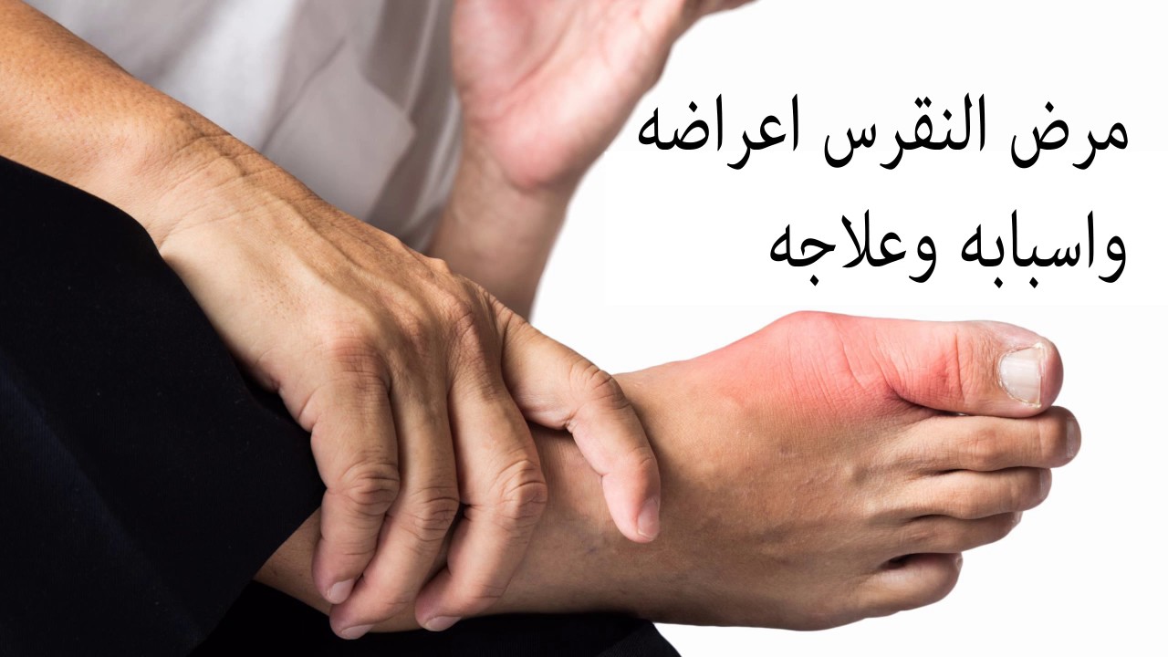 اعراض النقرس - الوقاية من النقرس واعراضه وعلاجه 4657 1