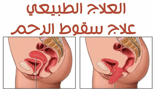 عملية هبوط المهبل , علاج هبوط المهبل