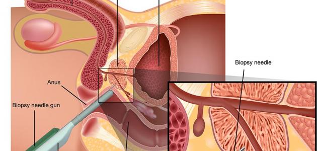علاج البروستاتا - كيفية التعافى من البروستاتا 2507 1