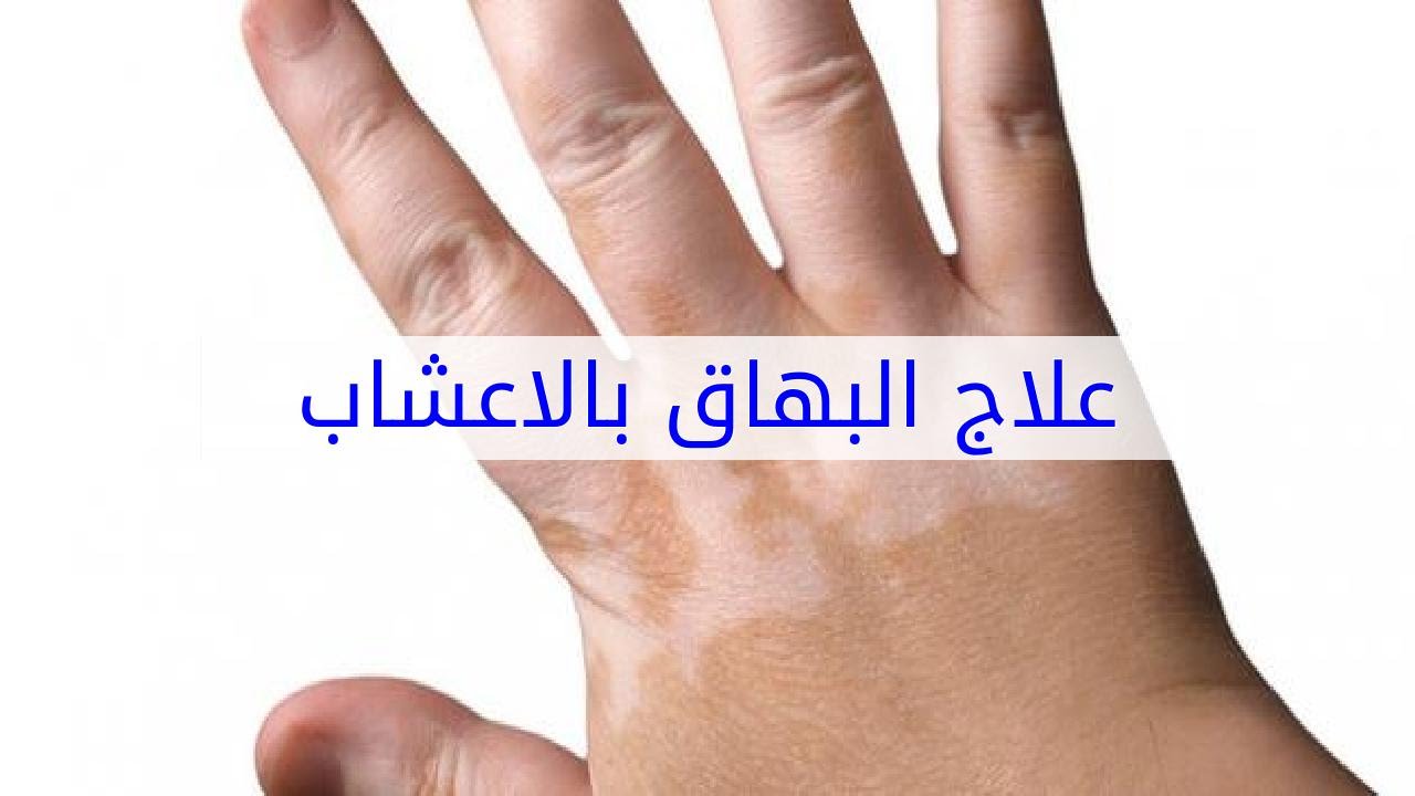 مرض البهاق , اعراض مرض البهاق وطرق علاجه