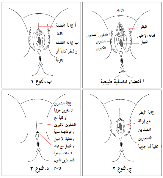 عايزه تختني بنتك وخايفه - شرح عملية الختان للبنات بالصور 12171