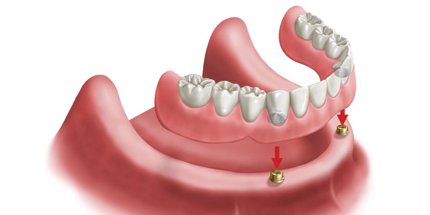 طقم اسنان - ثابت ومتحرك ومريح 879 9