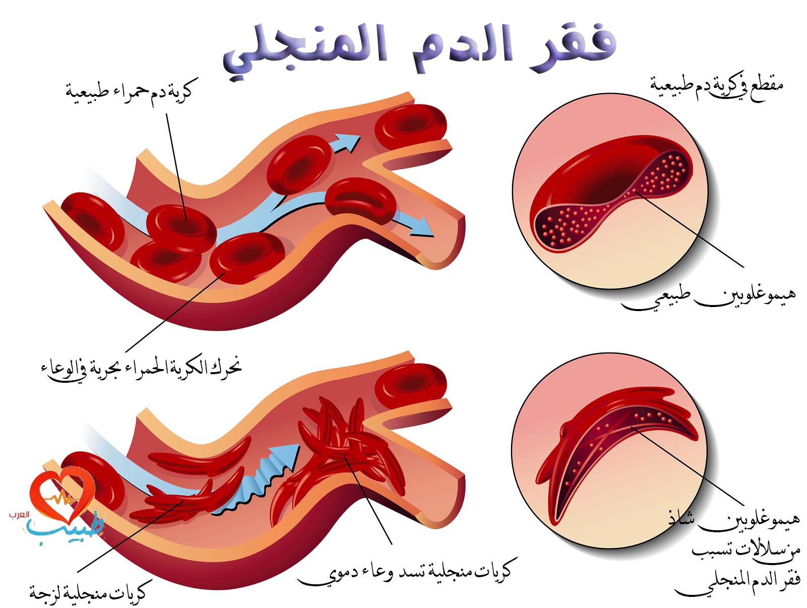 مرض فقر الدم - اسباب فقر الدم 5811 2