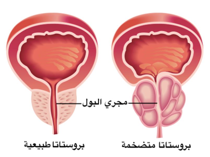 افضل مضاد حيوي لالتهاب البروستاتا 13072 1