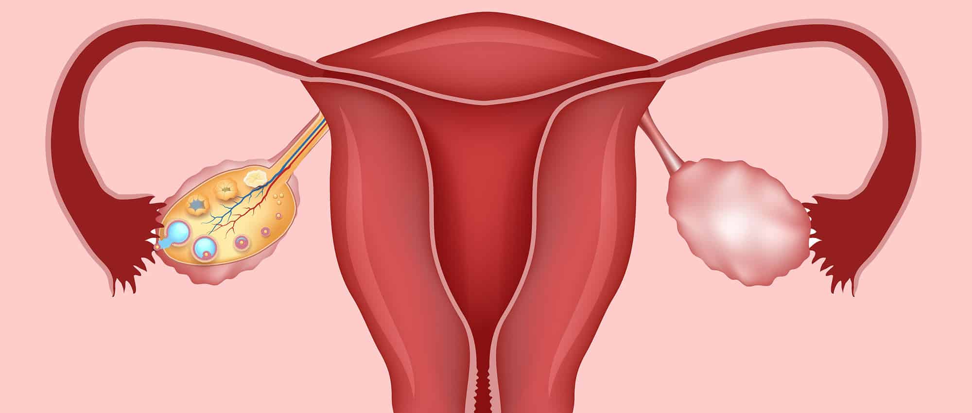 ماهي اعراض تكيس المبايض , علامات تدل على انكي مصابه بتكيس المبايض