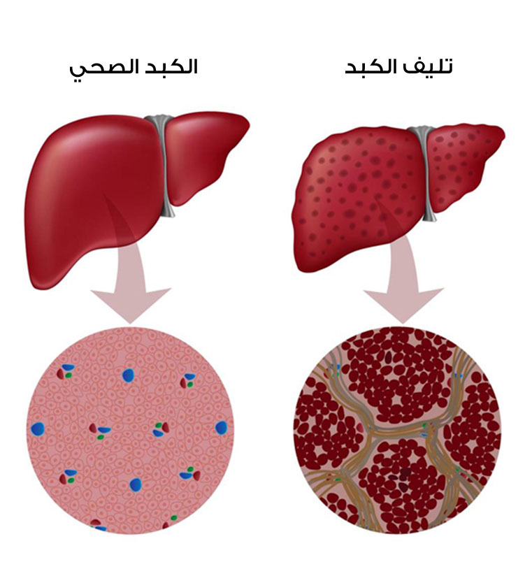 علاج تليف الكبد , اهم طرق علاج تليف الكبد