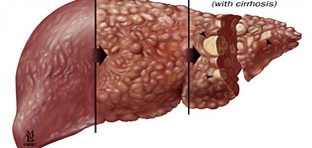 مرض الكبد الوبائي - علاماتة واعراضة وطرق علاجة 1150 1