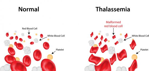 مرض الثلاسيميا - اهم المعلومات عنه 3196 2