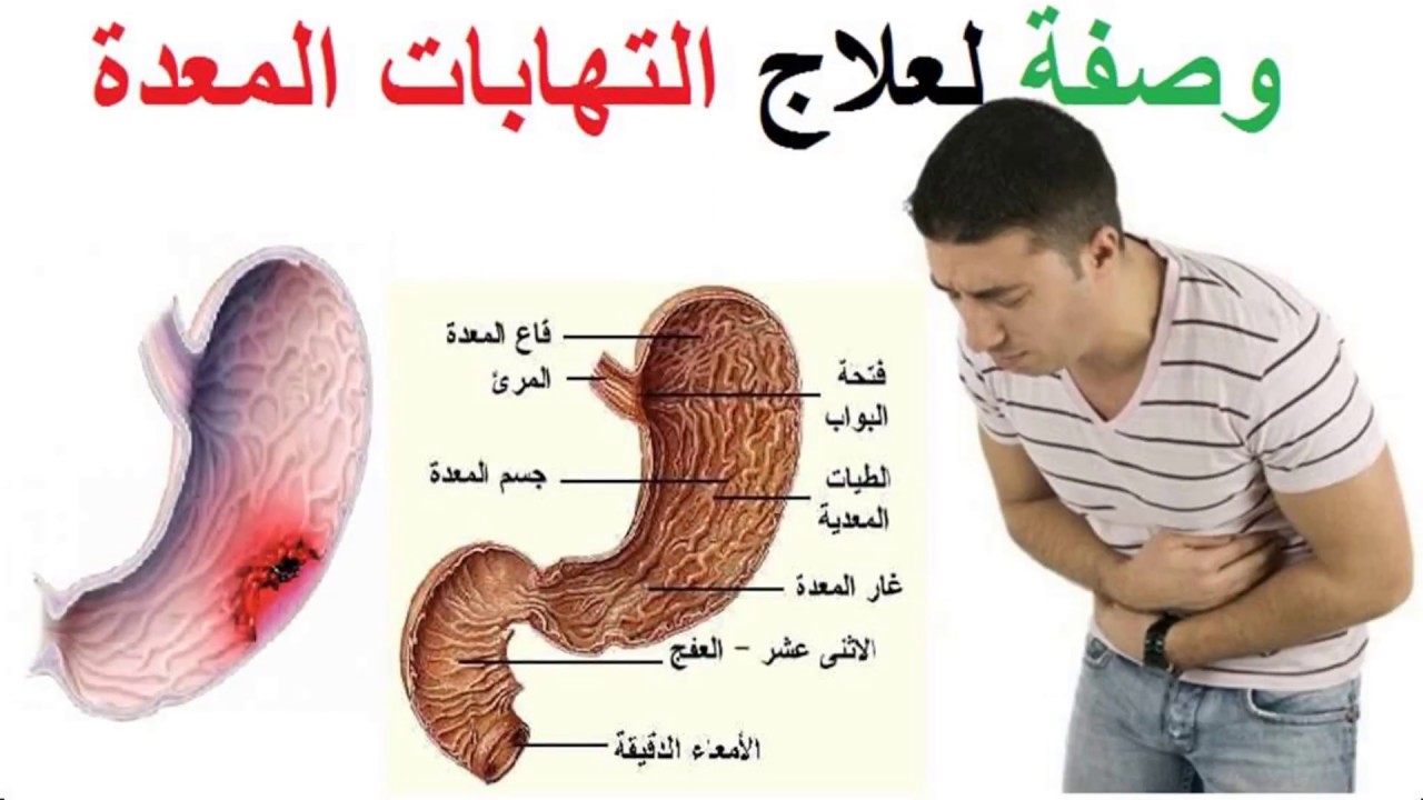 اعراض قرحة المعدة - وصفات طبيعية لعلاج قرحة المعدة 1765 3