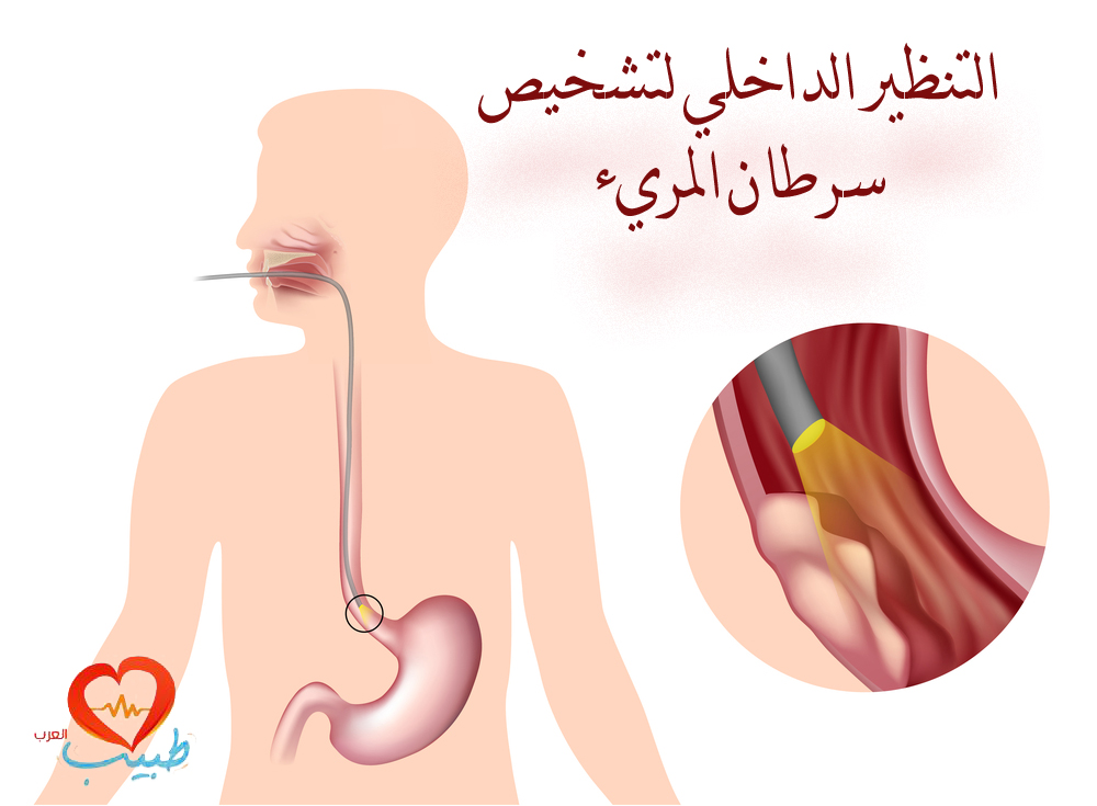 اعراض سرطان المريء - كيف يتم تشخيص مرض السرطان 4812 2