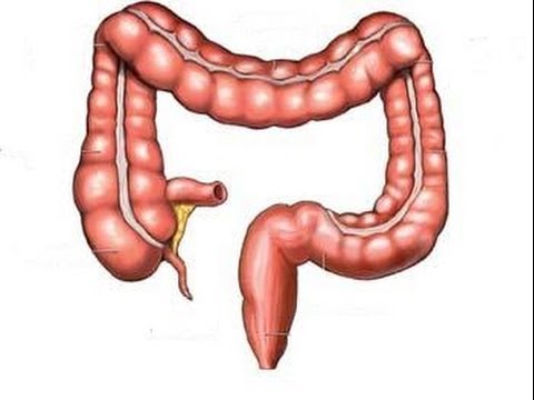 اعراض سرطان القولون - اهم الاعراض وطرق العلاج 3078