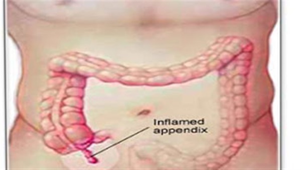 اعراض الزائدة الدودية - من يعانى من الزائدة الدودية 2243
