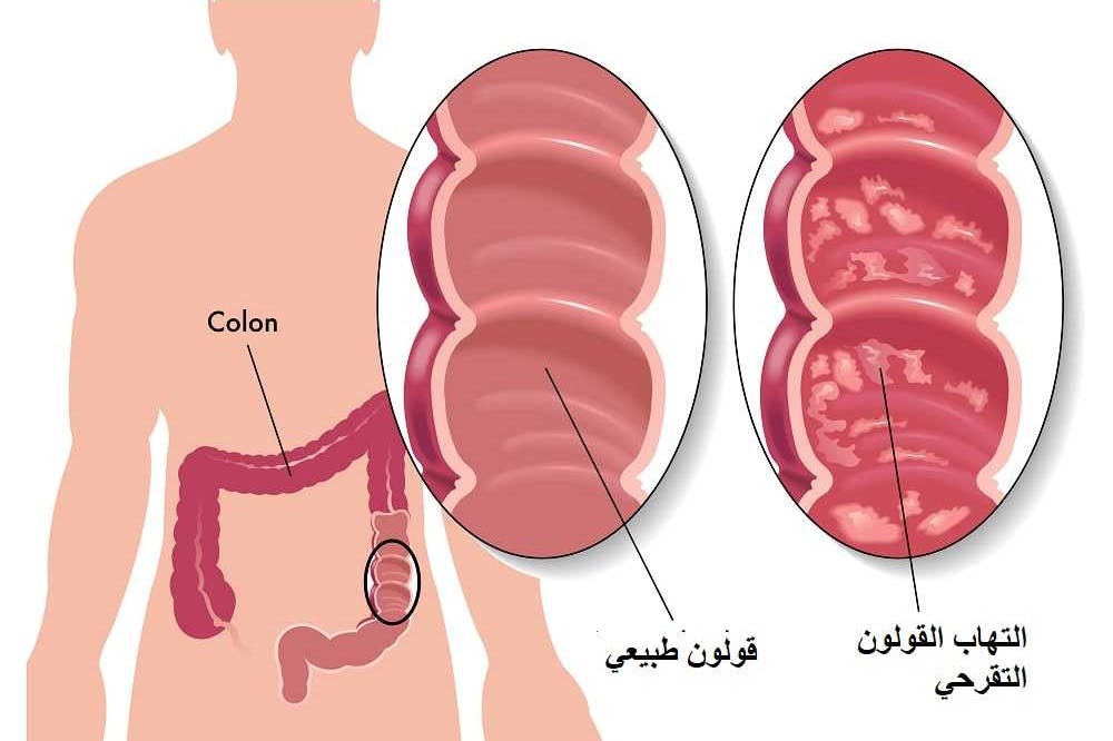 اعراض التهاب القولون - علاج القولون واعراضه 2988 1