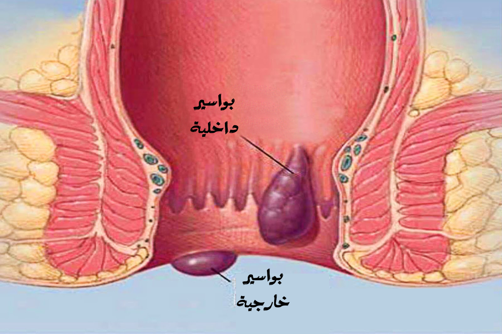 علاج البواسير - الطرق المختلفه فى علاج البواسير 3594 1