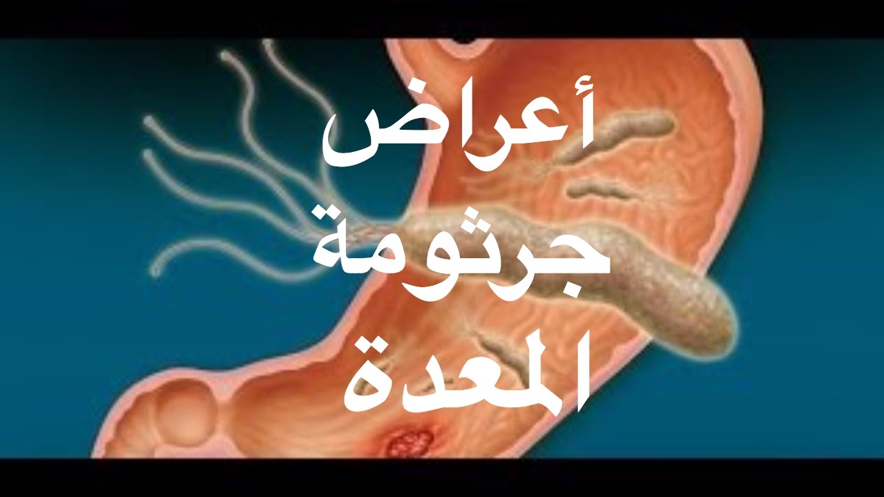 اعراض جرثومة المعدة - لها الكثير من الاعراض 6280 3