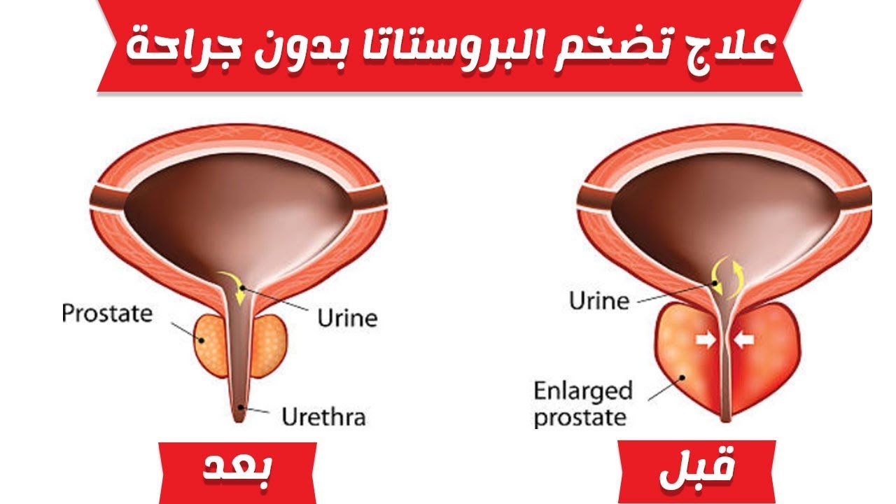 علاج تضخم البروستاتا - الحفاظ على البروستاتا 6216 2