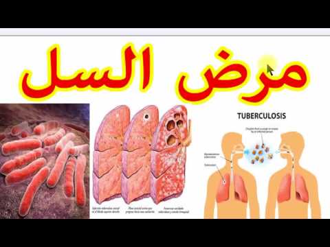 علاج مرض السل , اهم طرق علاج مرض السل