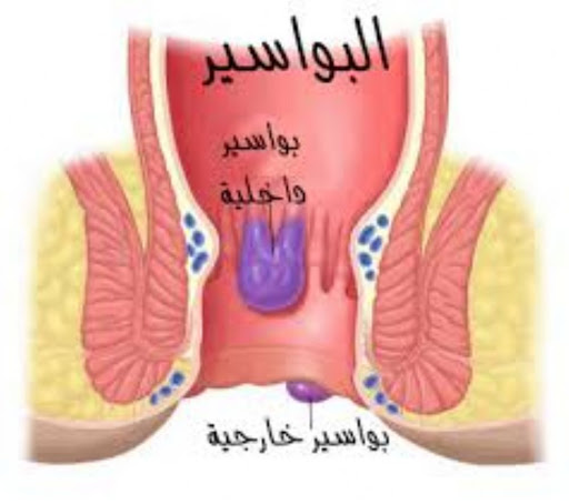 اسباب البواسير , ما هى البواسير واسبابها ؟؟