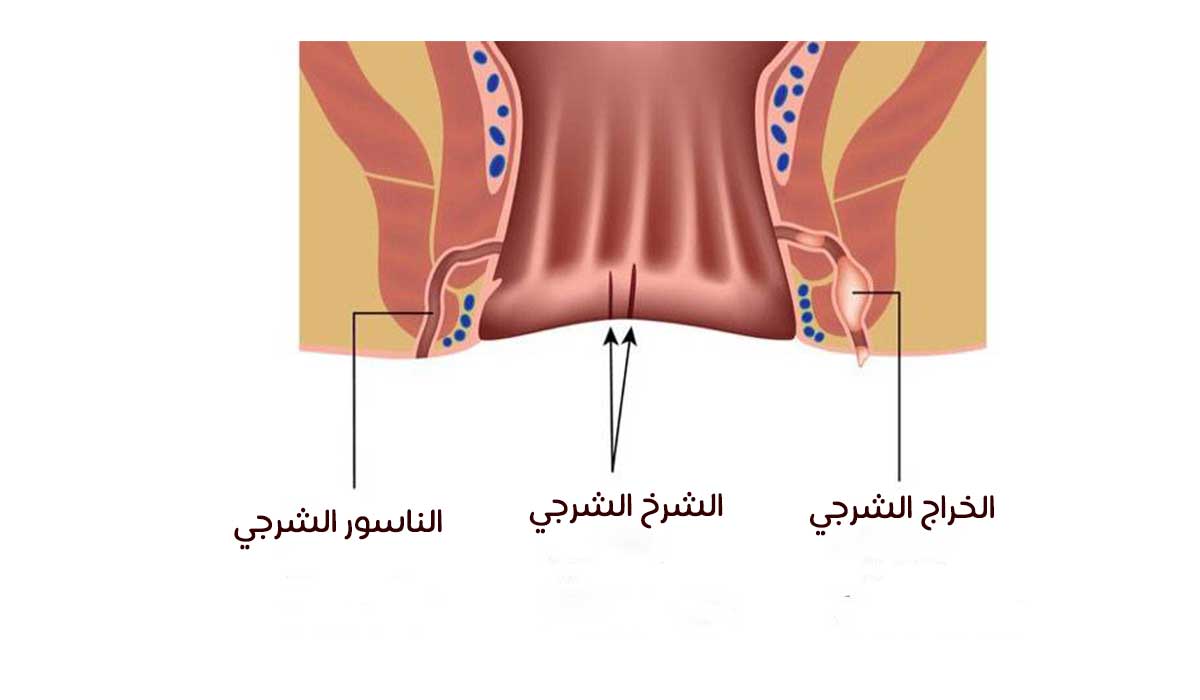 ما هو الناسور - لم يعرفه الكثير 6389 1