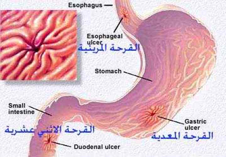 اعراض قرحة المعدة - وصفات طبيعية لعلاج قرحة المعدة 1765 1