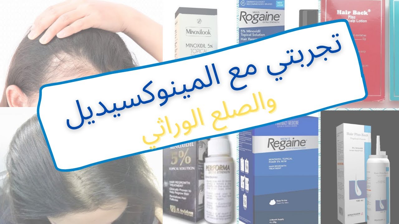 minoxidil 5 تجربتي , ممكن نعرف اثاره على الشعر