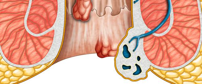 اعراض البواسير- ما هى اعراض البواسير 6677 2