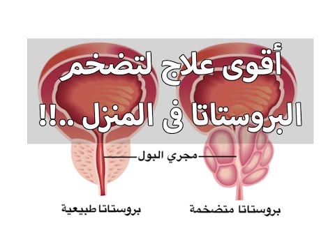 علاج البروستاتا - كيفية التعافى من البروستاتا 2507 2