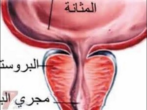 علاج البروستاتا , كيفية التعافى من البروستاتا