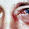 2929 2 علاج حساسية العين - تعرف على الخطوات دجانة جوهر